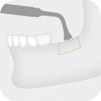 Illustration of an oral and maxillofacial surgery procedure depicting a W&H Piezomed Bone Surgery Tip positioned near the lower jaw, with a dotted line marking a rectangular section along the jawbone, highlighting the use of W&H’s atraumatic bone cutting techniques.