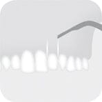 Illustration of a W&H Piezomed Bone Surgery Tip being used by a dental professional to place a veneer or similar covering onto an upper tooth, suggesting a cosmetic oral and maxillofacial procedure performed with W&H precision instruments.