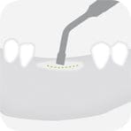 Illustration of a dental procedure featuring the W&H Piezomed Bone Surgery Tips by W&H, showing the tool working on the gums between two upper teeth with dotted lines marking the treatment area—demonstrating advanced atraumatic bone cutting techniques used in oral and maxillofacial surgery.