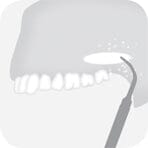 Illustration of dental cleaning, showing teeth with a dental scaler removing plaque or debris from the surface of a molar in an open mouth—a procedure essential for maintaining oral health and often performed alongside advanced techniques such as atraumatic bone cutting using W&H Piezomed Bone Surgery Tips by W&H in oral and maxillofacial surgery.