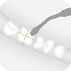 Illustration of a W&H Piezomed Bone Surgery Tip performing atraumatic bone cutting on a molar tooth, with dotted lines indicating the targeted areas. The mouth and teeth are depicted in a simplified white style, reflecting techniques frequently utilized in oral and maxillofacial surgery.