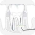 W&H Piezomed Retrograde Endodontic Tips