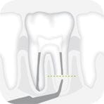 W&H Piezomed Retrograde Endodontic Tips