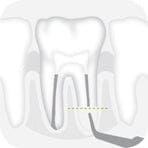 W&H Piezomed Retrograde Endodontic Tips