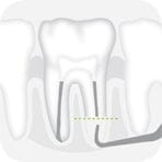 W&H Piezomed Retrograde Endodontic Tips