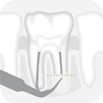 W&H Piezomed Retrograde Endodontic Tips
