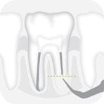 W&H Piezomed Retrograde Endodontic Tips