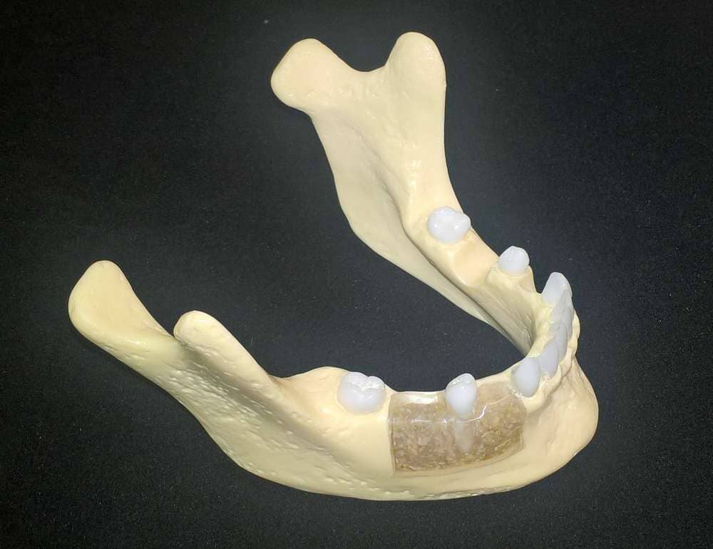 The Models Plus Ridge Preservation Model displays a lower jaw with teeth and a section of bone graft, ideal for patient education, set against a black background.