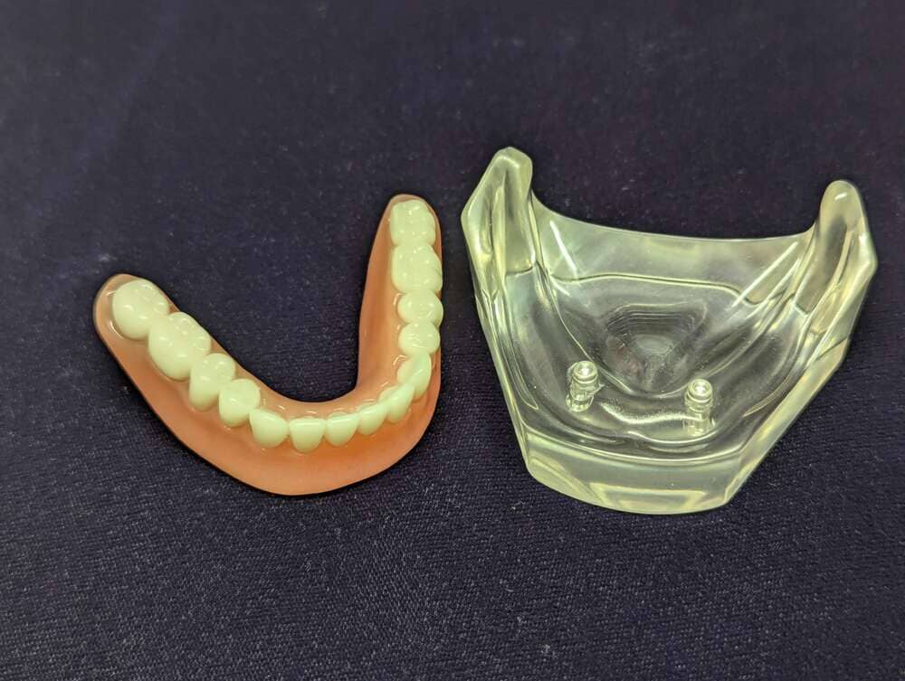 The Models Plus Locator Implant Patient Education Model, featuring two visible metal implants with lower implant-retained overdentures, is displayed on a dark surface.