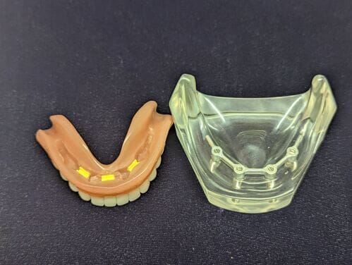 The Models Plus Hader Bar Implant Patient Education Model, featuring lower dentures with yellow markers and a clear impression tray on a dark surface, is perfect for demonstrating implant-retained overdentures to patients.