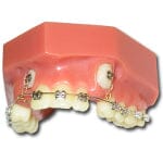 The Xemax Surgical Products Inc. Cusp-Lok® Patient Cuspid Exposure Education Model with Braces displays crooked teeth with metal braces and wires, effectively serving as an orthodontic visual aid for demonstrating tooth alignment treatment.