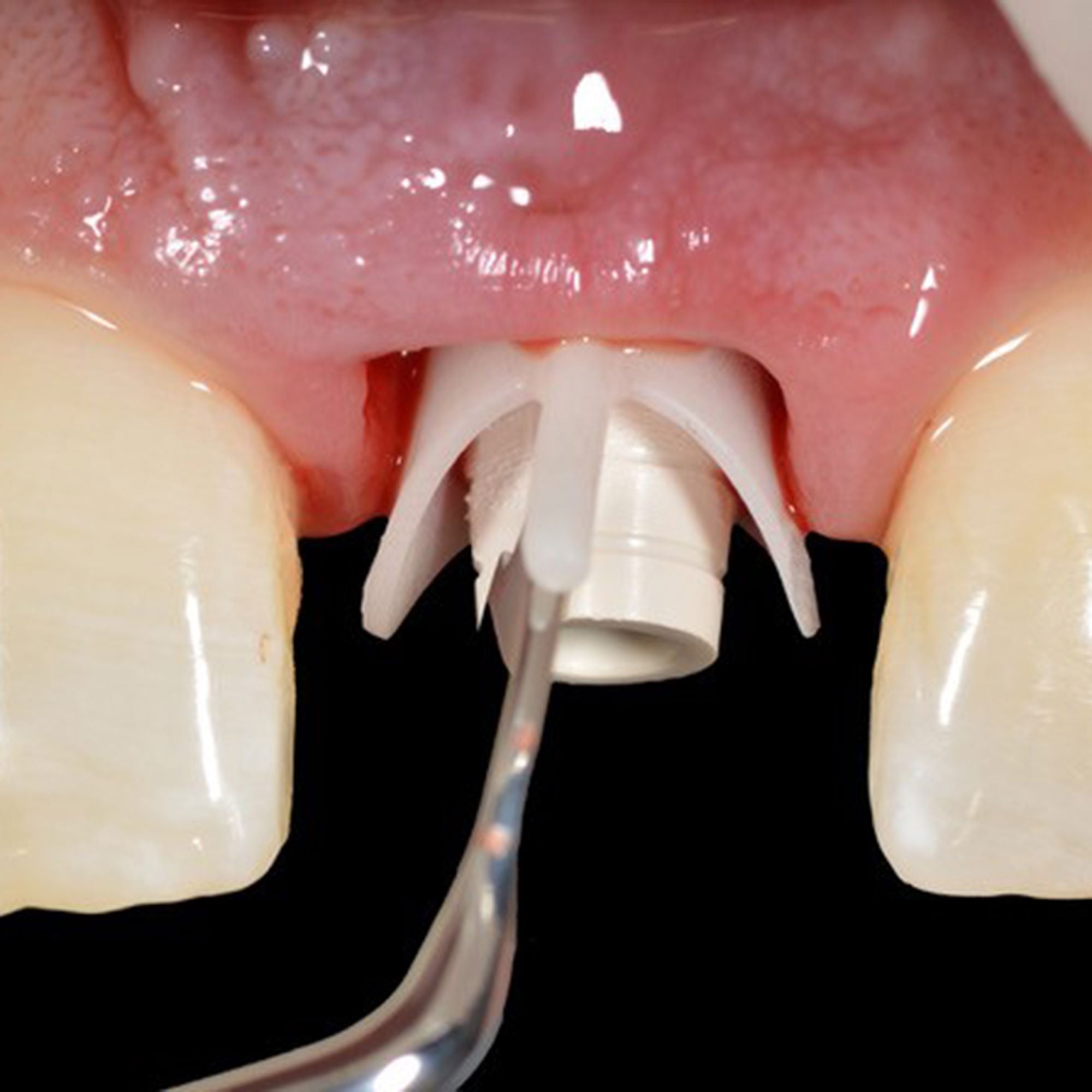 Hu-Friedy Chu Prosthetic Placement Instrument