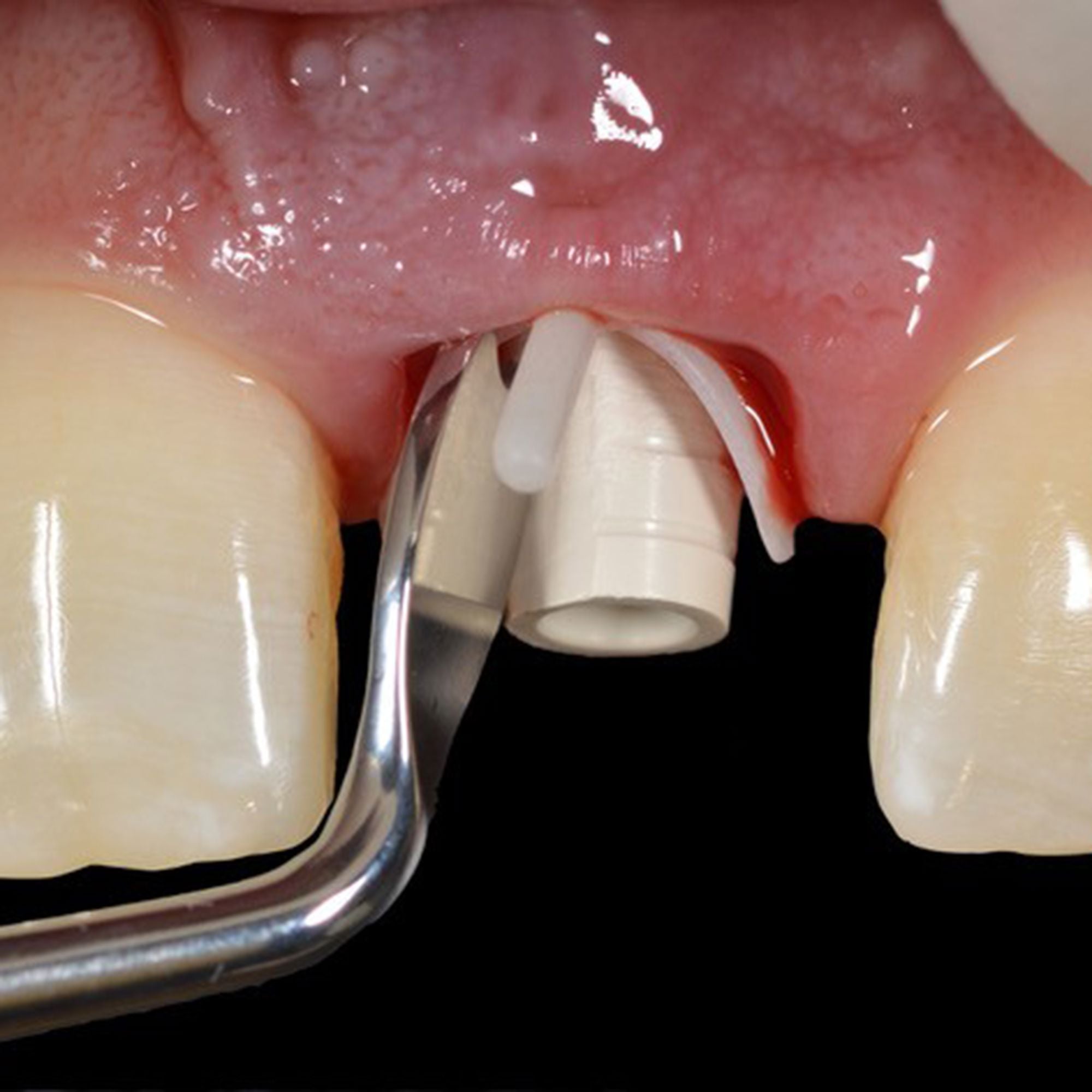 Hu-Friedy Chu Prosthetic Placement Instrument