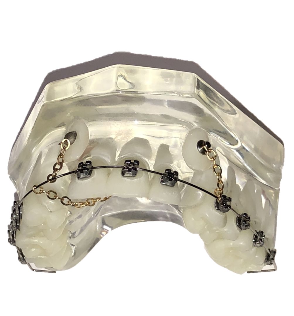 The Cusp-Lok Cuspid Exposure Patient Education Model with Braces CLEAR base by Xemax Surgical Products Inc. shows clear teeth with orthodontic braces and a gold-colored wire fitted to the lower jaw brackets.