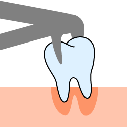 Extraction & Socket Preservation
