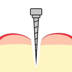 Implant Placement