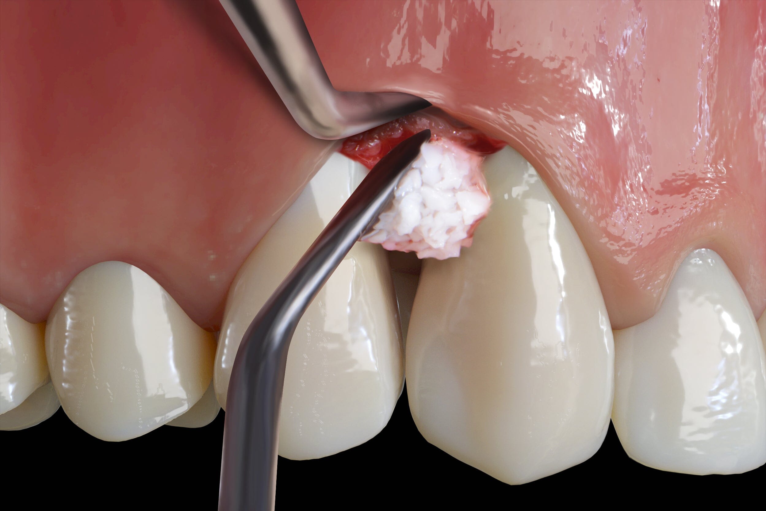 A close-up illustration highlights the use of the Hu-Friedy Pink Matters PM Split Periosteal, Short, Black Line to place bone graft material into the upper gum above a front tooth during periodontal surgery for treating bone loss after flap elevation.