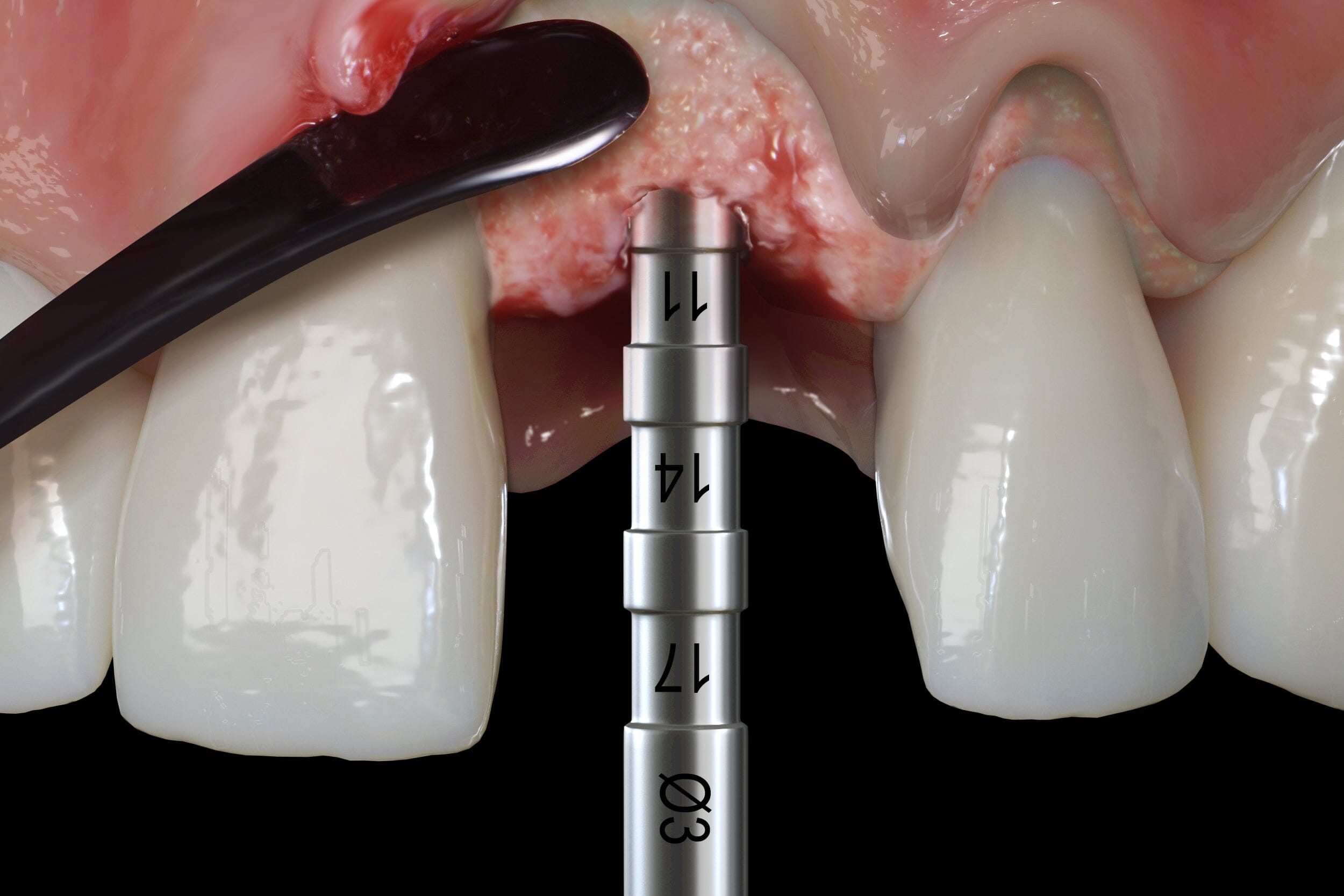 Close-up of periodontal surgery showing a metal dental implant drill with measurement markings in the gum above front teeth, while a Hu-Friedy Pink Matters PM Split Periosteal, Short, Black Line is used for flap elevation.