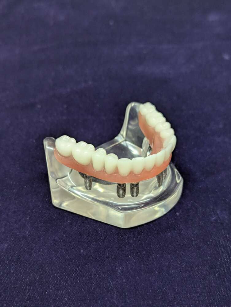 The Models Plus Screw-Retained Full-Arch Bridge on 6 Implants patient education model shows a lower jaw with artificial teeth on six implants, set on a clear base against a dark purple background.