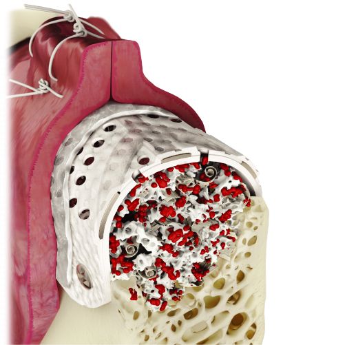 Medical illustration of a shoulder joint with bone structure, soft tissue, and an artificial implant. Osteogenics RPM™ Reinforced PTFE Mesh Membrane (Box/1) is shown supporting guided bone regeneration and graft integration.