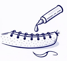 Sutures & Wound Closure